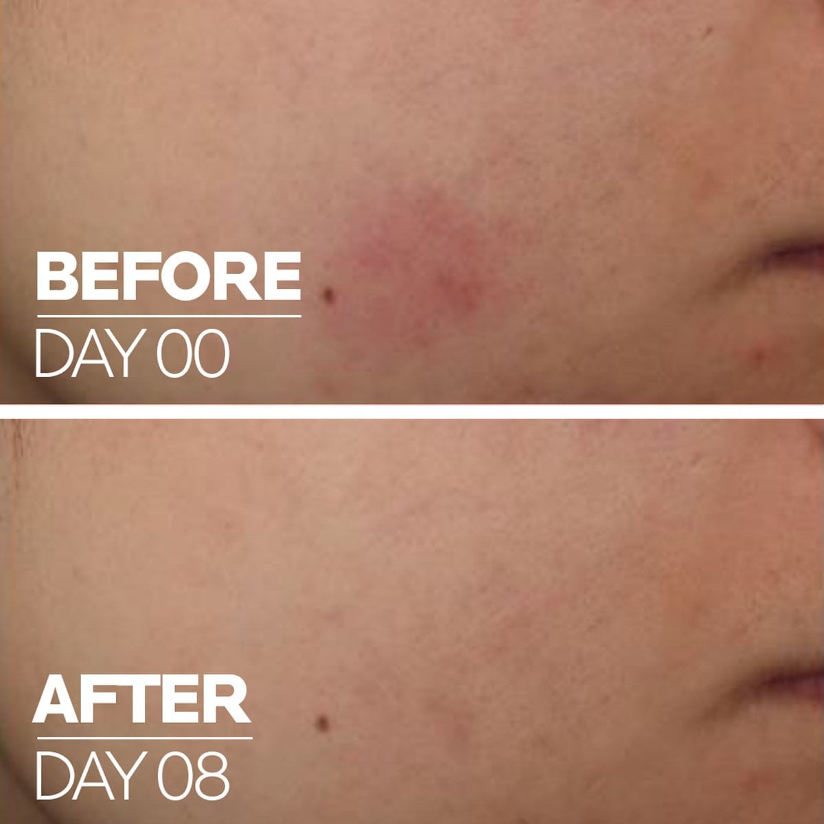 rp_skbc_cicaplast_vitaminb5_beforeafter